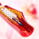 angioplastica-carotidea