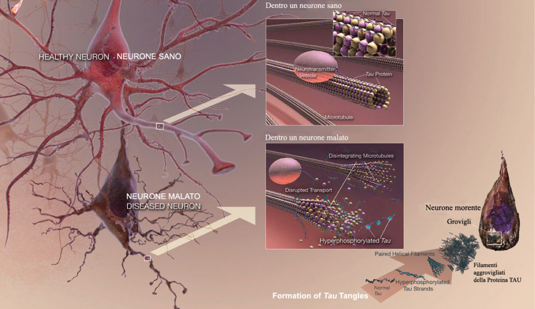 Alzheimer- Proteina TAU