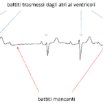 blocco-atrio-ventricolare