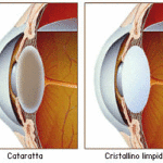 cataratta-iconografia