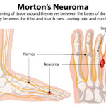 Morton’s Neuroma Illustration