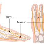 Diagram showing nerve thickening in the foot